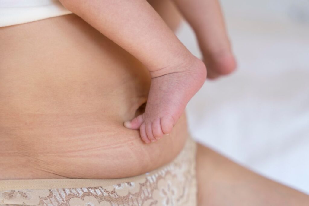 Loose Skin After Pregnancy