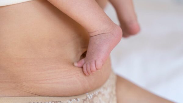 Loose Skin After Pregnancy