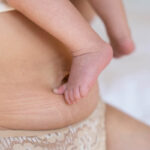 Loose Skin After Pregnancy: Manage to Embrace and Manage Postpartum Skin 5 Loose Skin After Pregnancy