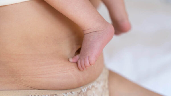 Loose Skin After Pregnancy: Manage to Embrace and Manage Postpartum Skin 11 Loose Skin After Pregnancy